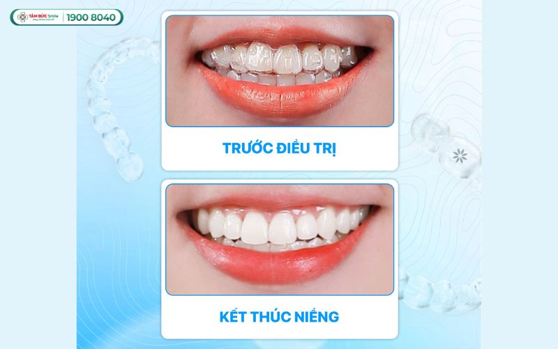 nieng-rang-tre-em-gia-bao-nhieu-5