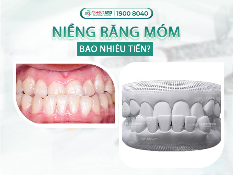 Niềng răng móm bao nhiêu tiền? Bảng giá chi tiết tại Nha khoa Tâm Đức Smile