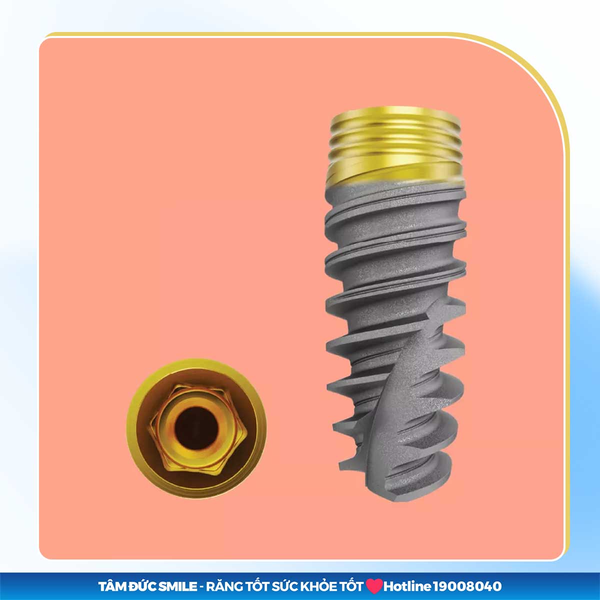Implant Nobel Active TiUltra: Trụ cao cấp với công nghệ TiUltra chống viêm nướu