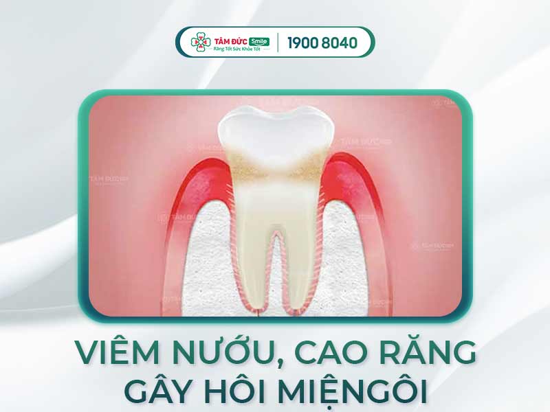 Nước bọt có mùi hôi: Dấu hiệu bệnh lý, nguyên nhân và cách xử lý hiệu quả