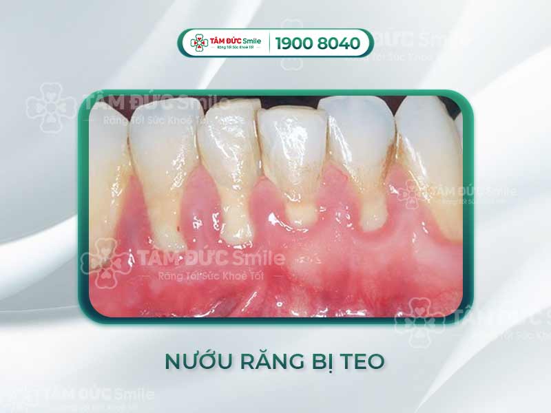 Nướu răng bị teo: Nguyên nhân, dấu hiệu và cách điều trị tụt lợi hiệu quả