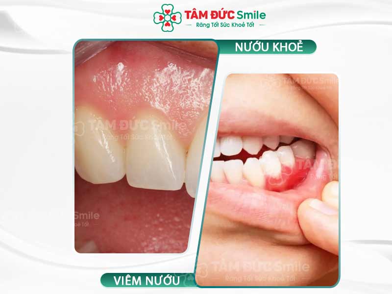 Nướu răng bình thường có màu gì? Dấu hiệu nướu khỏe và cách chăm sóc đúng