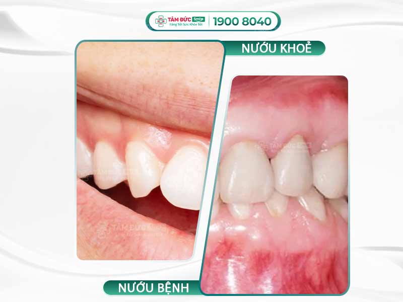 Nướu răng là gì? Cấu tạo, chức năng và dấu hiệu bất thường thường gặp