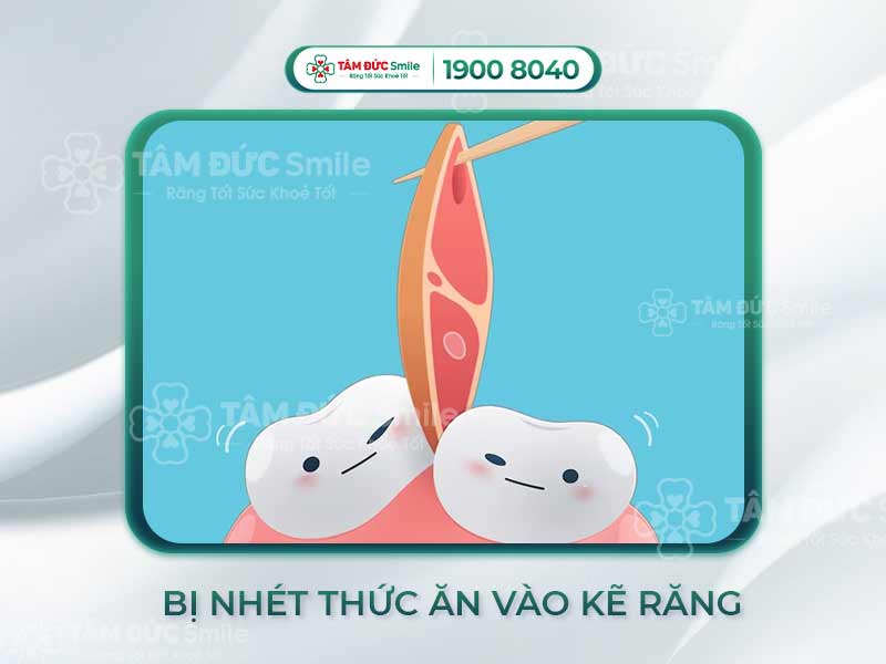Dắt thức ăn sau khi ăn: Nguyên nhân, hậu quả và cách xử lý hiệu quả