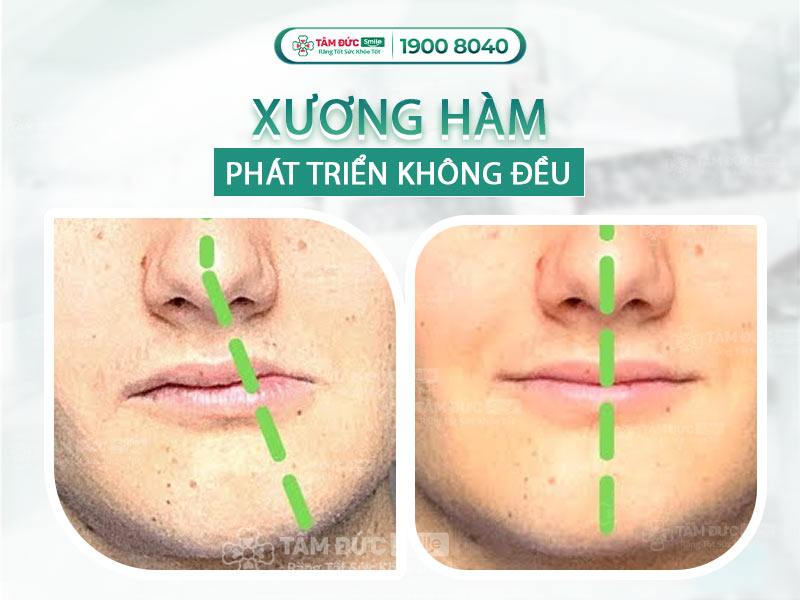 Xương hàm không đều: Nguyên nhân, dấu hiệu và cách điều trị lệch khớp cắn hiệu quả