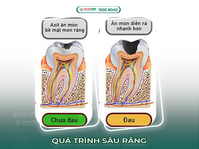Quá trình bị sâu răng: Giai đoạn, nguyên nhân và cách điều trị hiệu quả sớm nhất