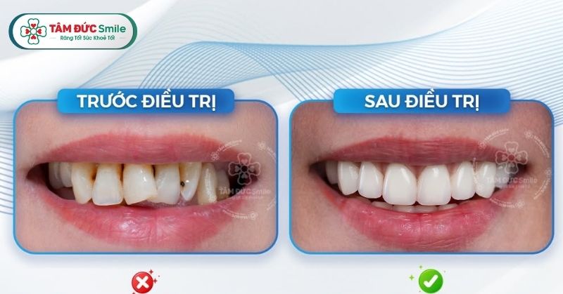 Quy trình bọc răng sứ thẩm mỹ chuẩn y khoa tại Nha khoa Tâm Đức Smile không đau
