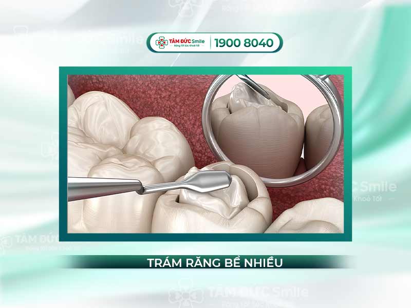 Răng bể nhiều có trám được không? Phương pháp điều trị & phục hồi hiệu quả
