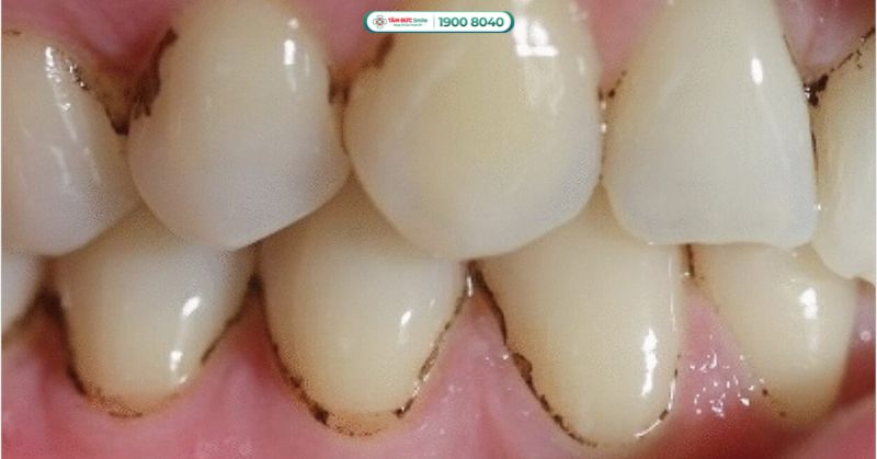 Răng bị đen ở kẽ: Nguyên nhân, cách xử lý mảng bám, sâu răng kẽ hiệu quả