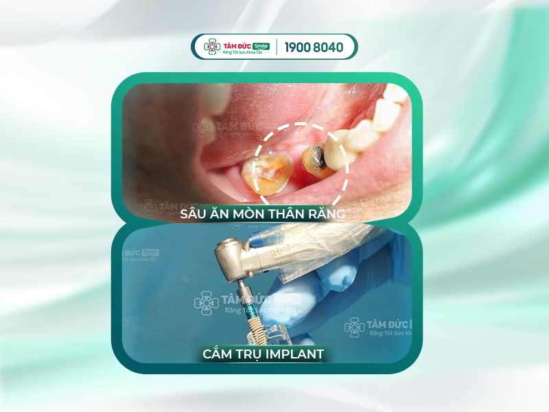 Răng bị sâu ăn mòn hết: Nguyên nhân, cách chữa và phòng tránh hiệu quả