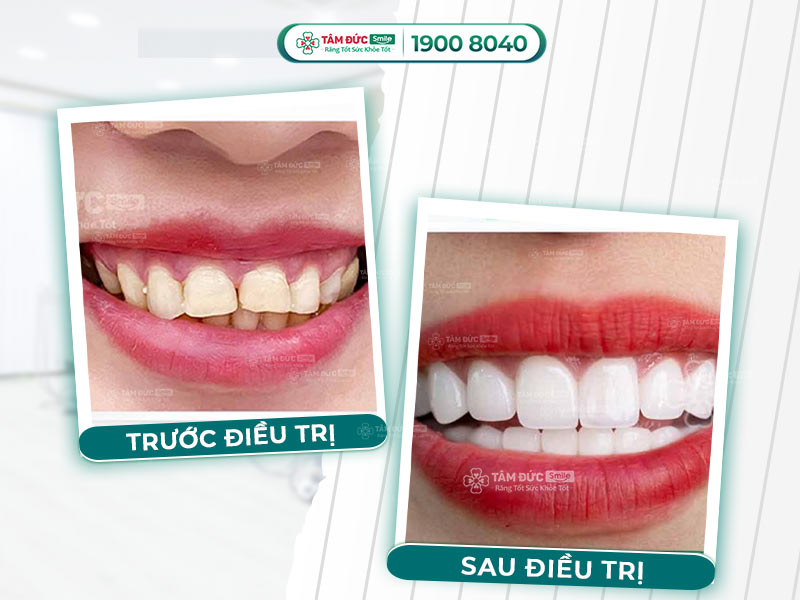 Răng cao răng thấp: Nguyên nhân, tác hại và cách điều trị