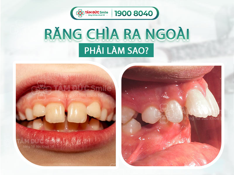 Răng chìa ra ngoài: Nguyên nhân, cách điều trị và niềng răng hô hiệu quả