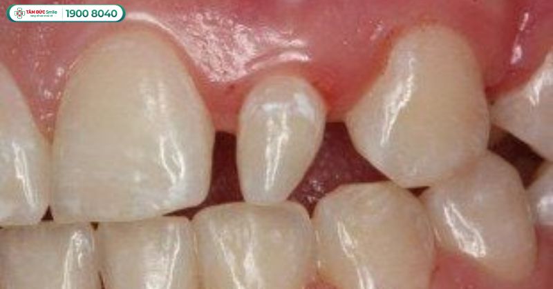 Răng chuột là gì? Dấu hiệu, cách điều trị thẩm mỹ tại Nha khoa Tâm Đức Smile