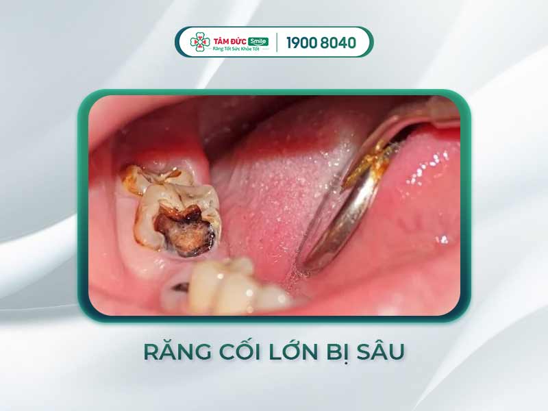 Nguyên nhân và cách điều trị răng cối bị sâu: Từ sâu nông đến ăn vào tuỷ