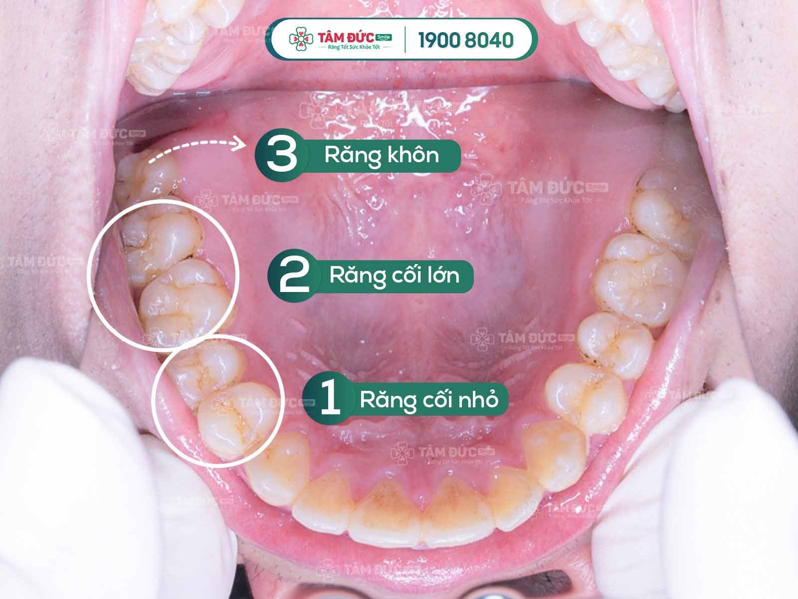 Răng cối có thay được không? Các phương pháp cấy ghép, phục hình và chi phí