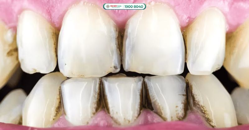 Răng đen: Nguyên nhân, cách điều trị tẩy trắng, trám thẩm mỹ, bọc sứ hiệu quả