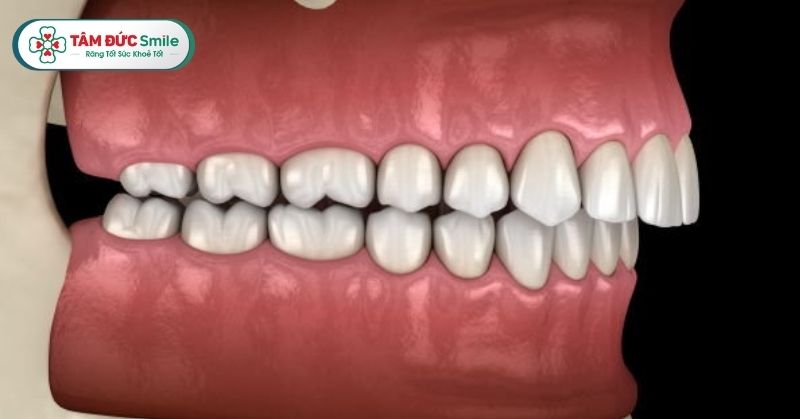 Răng hô nhẹ là gì? Niềng răng hô nhẹ có cần nhổ không? Bao lâu thì hết?