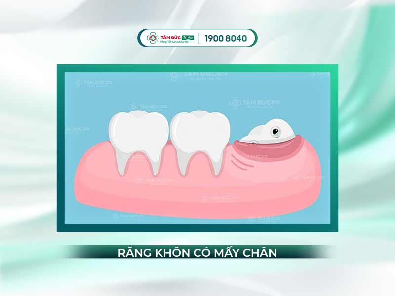 Răng khôn có mấy chân? Phân tích hình dạng, biến thể và cách nhận biết hiệu quả