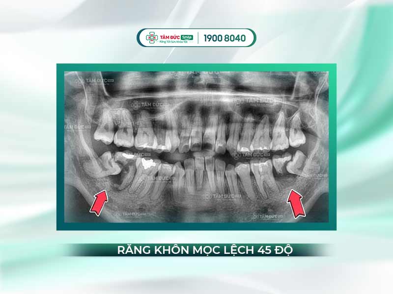Răng khôn mọc lệch 45 độ: Nguyên nhân, triệu chứng và cách xử lý hiệu quả
