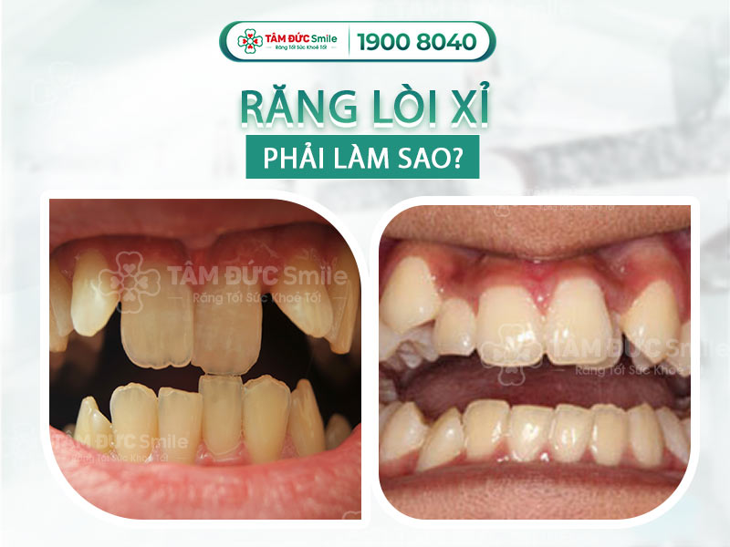 Răng lòi xỉ là gì? Nguyên nhân, cách điều trị và chi phí niềng răng chìa