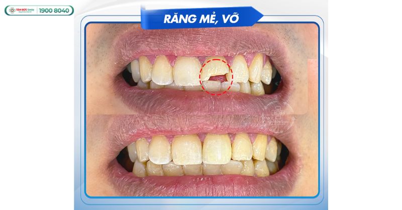 Răng mẻ, gãy, vỡ: Nguyên nhân, cách xử lý & phục hình thẩm mỹ an toàn
