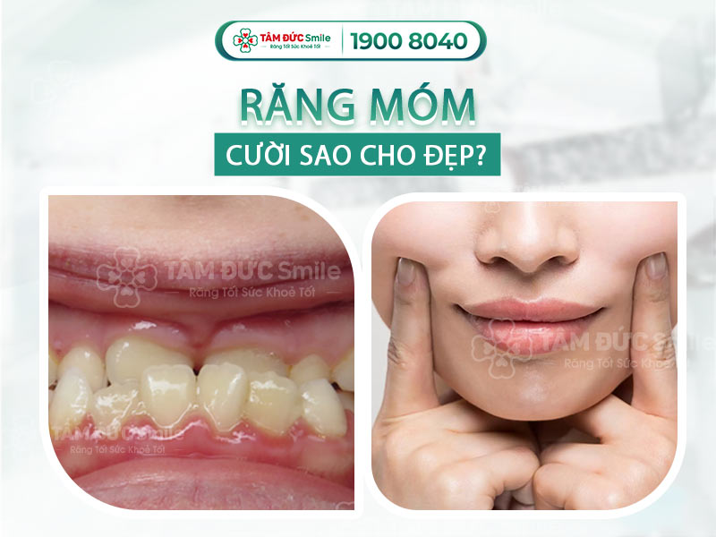 Răng móm cười sao cho đẹp? Cách tạo dáng và nụ cười tự nhiên cho người móm