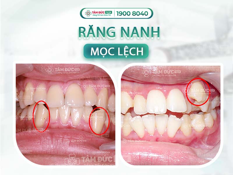 Răng nanh có thay không? Thứ tự thay, dấu hiệu & cách xử lý khi mọc lệch
