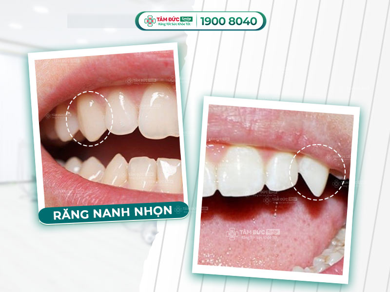 Răng nanh nhọn: Nhân tướng, thẩm mỹ và cách chỉnh răng nanh dài, nhô ra ngoài