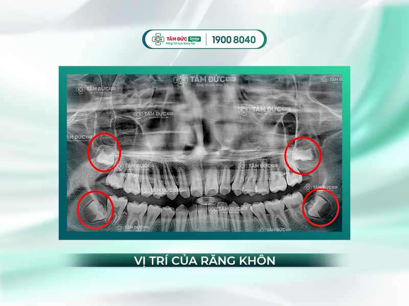 Răng khôn là gì? Cách xử lý đau, mọc lệch và nhổ răng khôn an toàn không đau