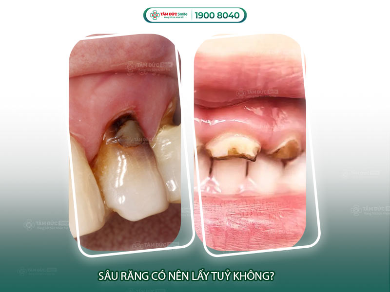 Răng sâu có nên lấy tủy không? Triệu chứng & giải pháp tại Nha khoa Tâm Đức Smile