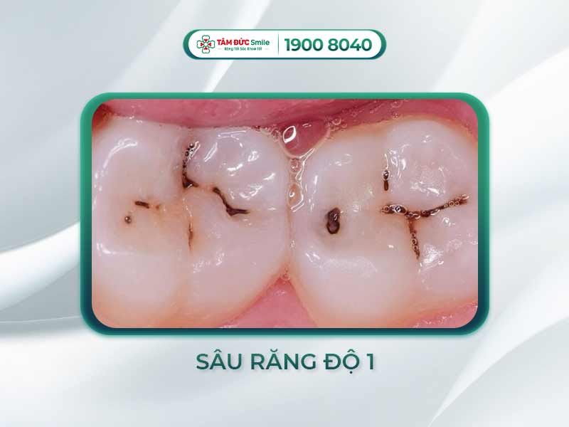 Răng sâu độ 1: Triệu chứng, cách điều trị và phòng ngừa hiệu quả từ sớm