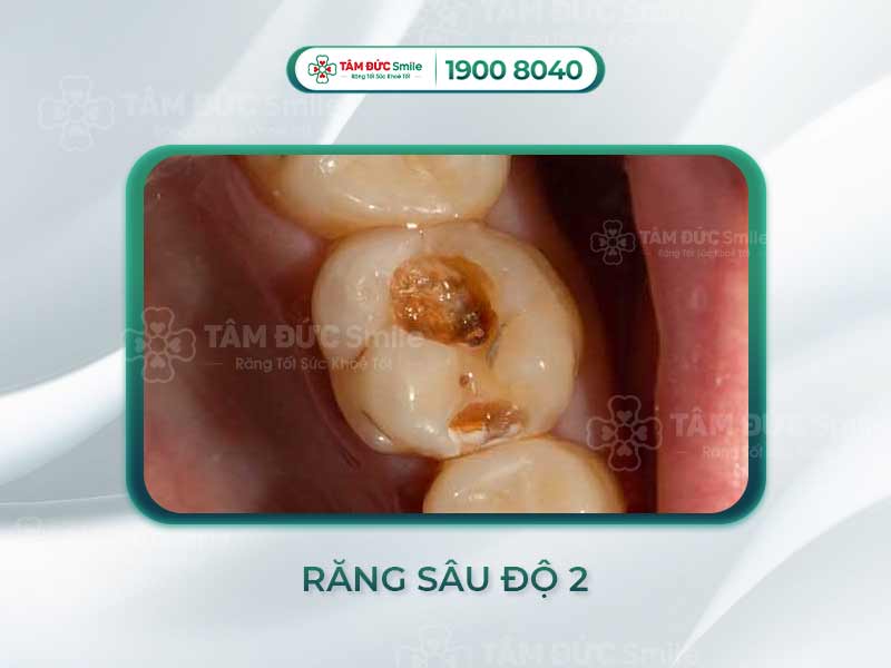 Răng sâu độ 2: Triệu chứng, cách điều trị hiệu quả tại Nha khoa Tâm Đức Smile