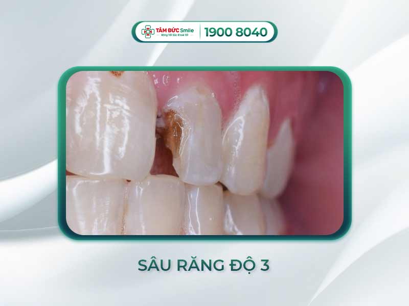 Răng sâu độ 3: Triệu chứng, nguy cơ và cách điều trị tại Nha khoa Tâm Đức Smile
