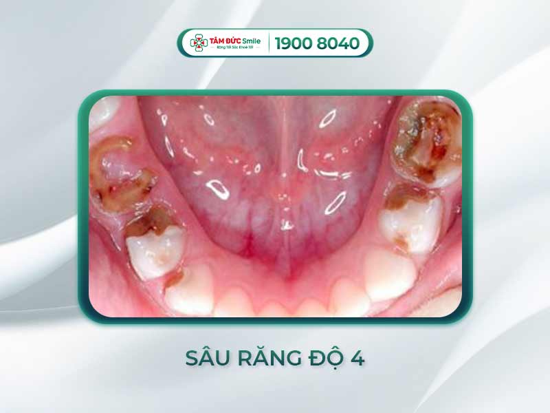 Răng sâu độ 4: Biểu hiện, điều trị và giải pháp không đau tại Nha khoa Tâm Đức Smile