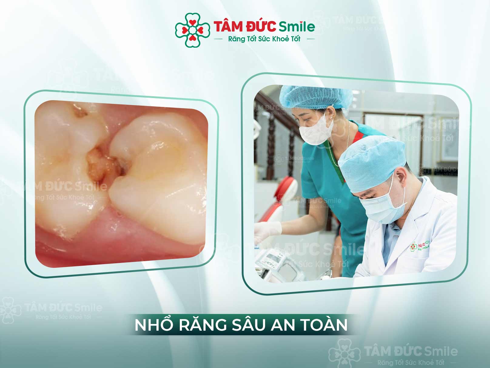 Sâu răng lồi thịt là gì? Nguyên nhân, biểu hiện và cách điều trị hiệu quả nhất