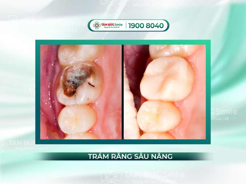 Răng bị sâu nặng có trám được không? Quy trình, chi phí và thời gian trám