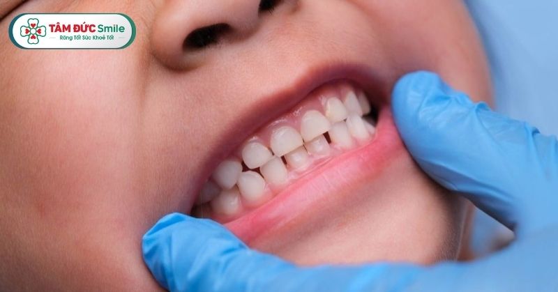 Răng sữa là gì? Thứ tự mọc, dấu hiệu rụng sớm và cách chăm sóc đúng chuẩn