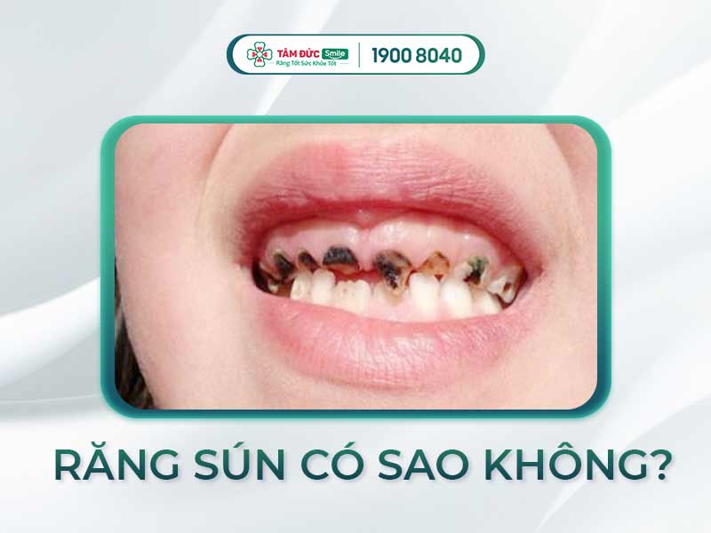 Trẻ bị sún răng có mọc lại không? Cách xử lý răng sữa hư tổn đúng cách