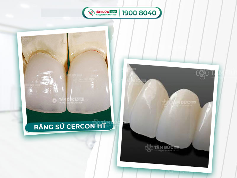 Răng sứ Cercon HT giá bao nhiêu? Bảng giá & Ưu điểm