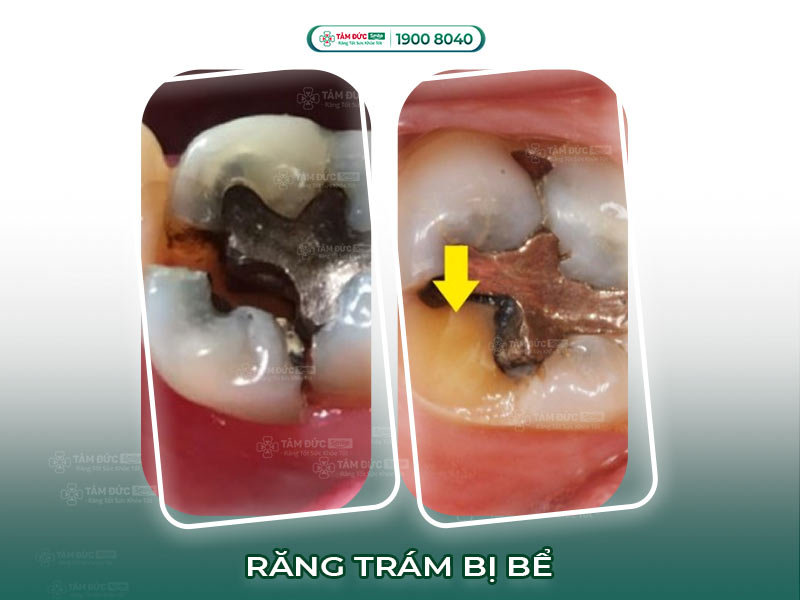 Răng trám bị bể, bong, sứt, mẻ: Nguyên nhân và cách xử lý an toàn, nhanh chóng