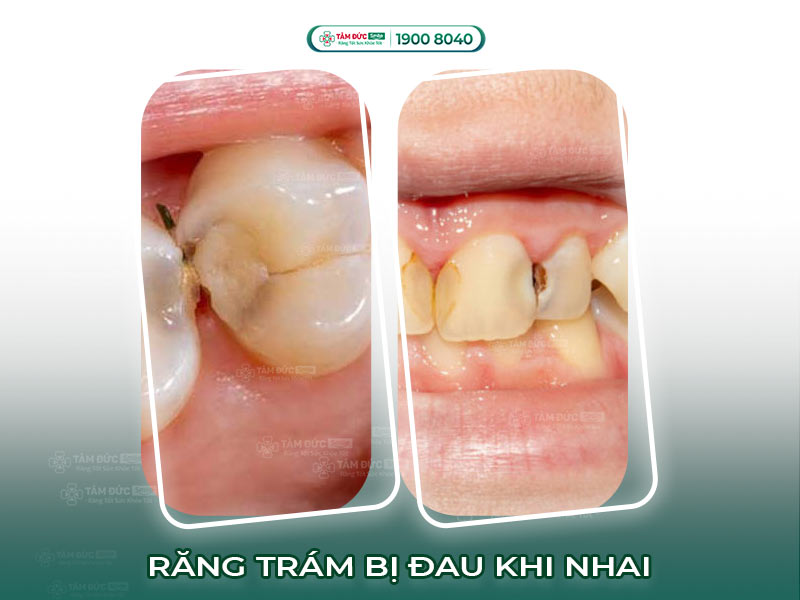 Răng trám bị đau khi nhai: Nguyên nhân, biến chứng và cách xử lý hiệu quả