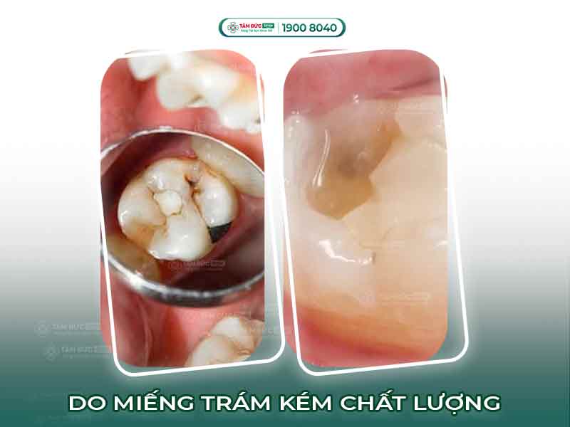 Trám răng xong bị nhức: Nguyên nhân, dấu hiệu và cách xử lý hiệu quả tại nhà