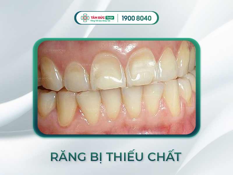 Răng yếu nên bổ sung gì? 15 dưỡng chất & thực phẩm giúp răng chắc khỏe