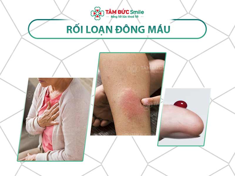 Rối loạn đông máu: Nguyên nhân, biểu hiện và điều trị hiệu quả hiện nay