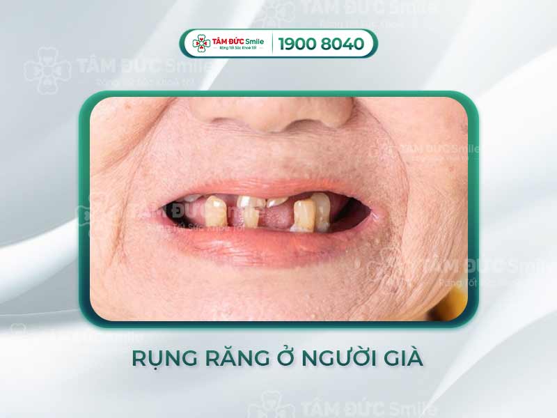 Rụng răng ở người già: Nguyên nhân, cách điều trị và giải pháp