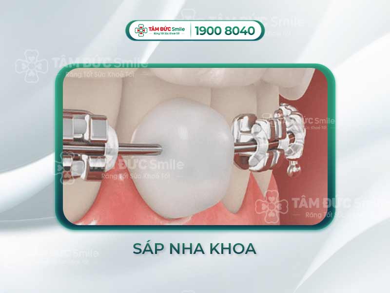 Sáp nha khoa là gì? Công dụng, cách dùng và lựa chọn sáp chỉnh nha phù hợp