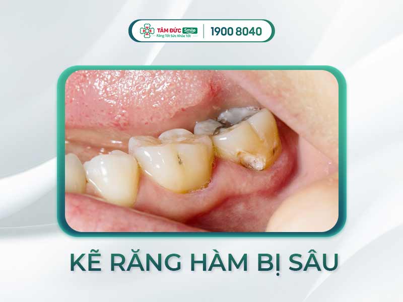 Cách phát hiện và điều trị sâu kẽ răng hiệu quả trước khi gây viêm tủy