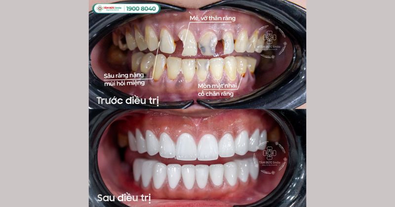 Sâu răng nặng: Dấu hiệu, biến chứng và cách điều trị dứt điểm không đau nhức