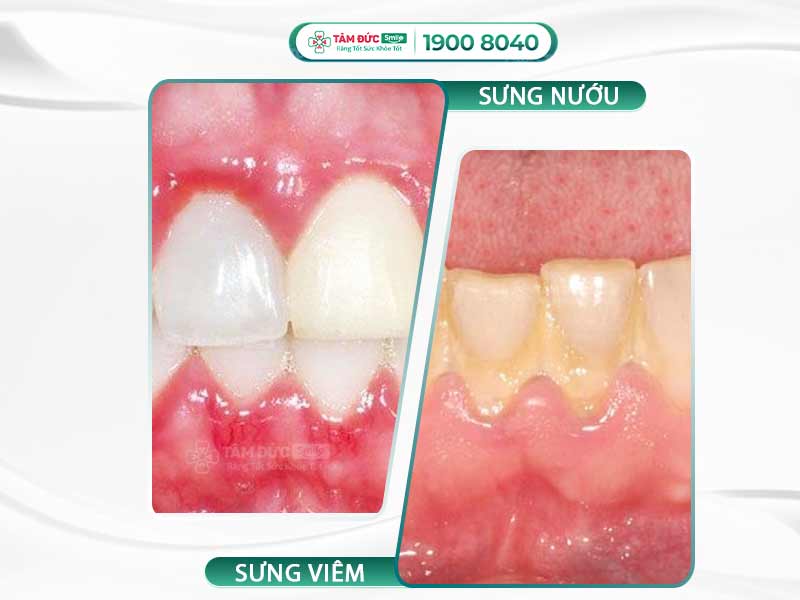 Sưng nướu răng có phải dấu hiệu mang thai? Phân biệt triệu chứng và nguyên nhân
