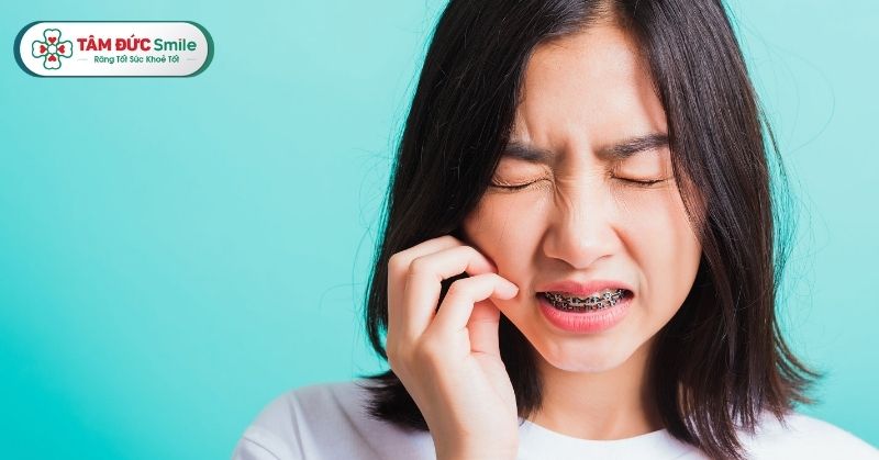 Tác dụng phụ niềng răng: Đau, viêm lợi, hóp má, sai khớp cắn có đáng lo?